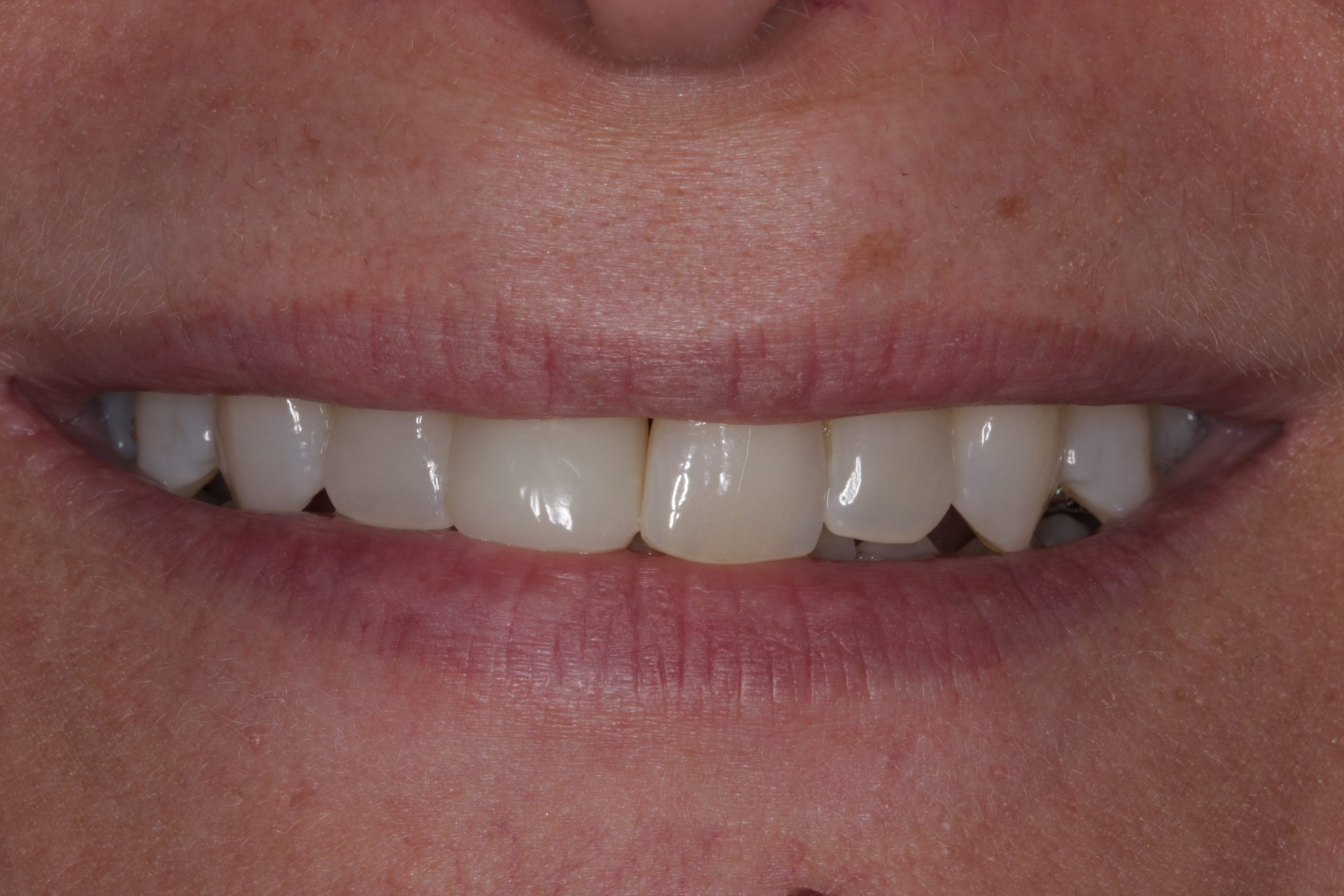 Efter plastfacade
