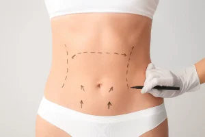 abdominoplastie cicatrice