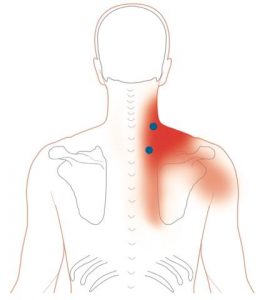 Neck Pain and Levator Scapulae Syndrome