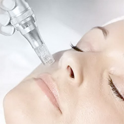 Microneedling