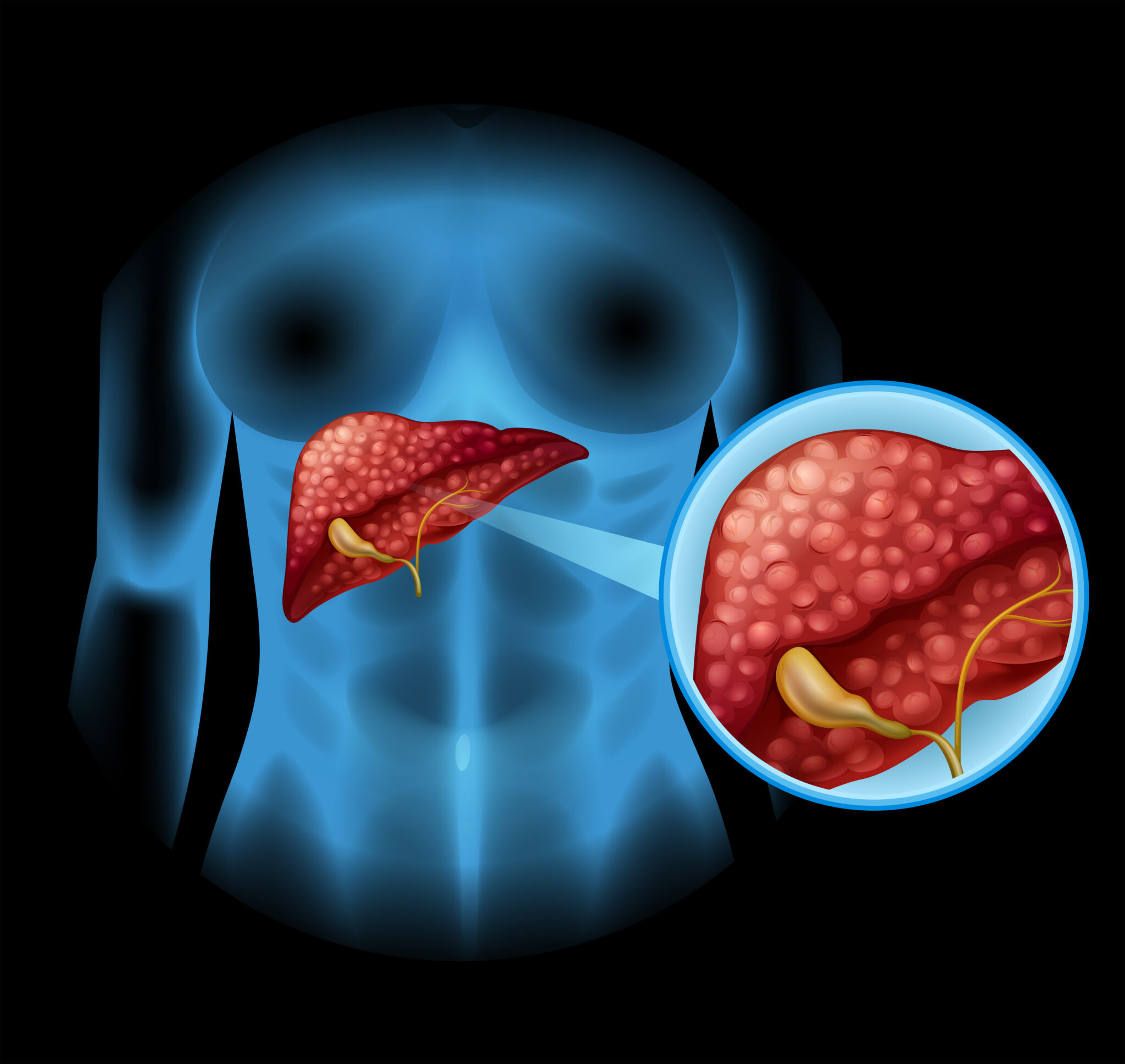 What is Wilson’s disease?