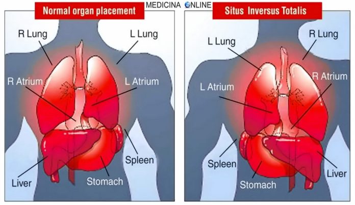 Situs inversus, tutti gli organi sul lato sbagliato del corpo