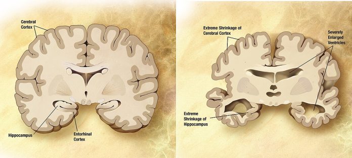 Demenza: sono 9 gli stili di vita a rischio