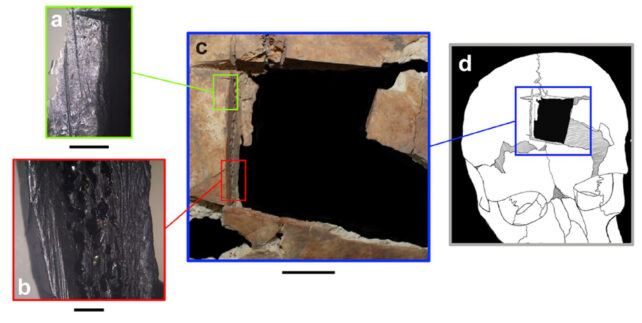 Segni di punteggio che circondano il sito di un foro di trapanazione non cicatrizzato nel cranio di Meggido (Kalisher et al., PLoS One , 2023)