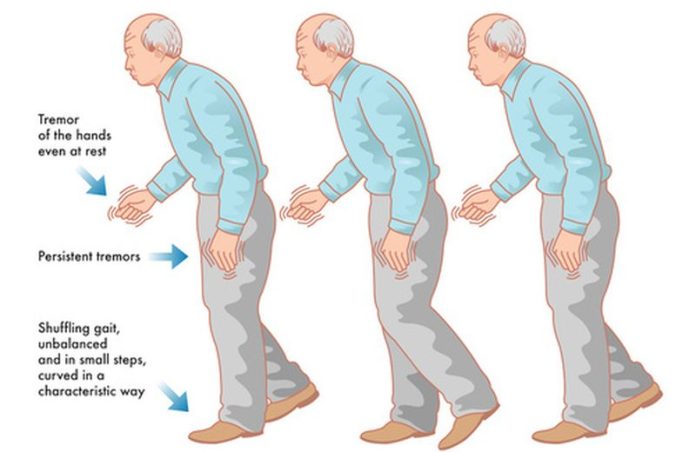 Una cura per i sintomi del Parkinson?