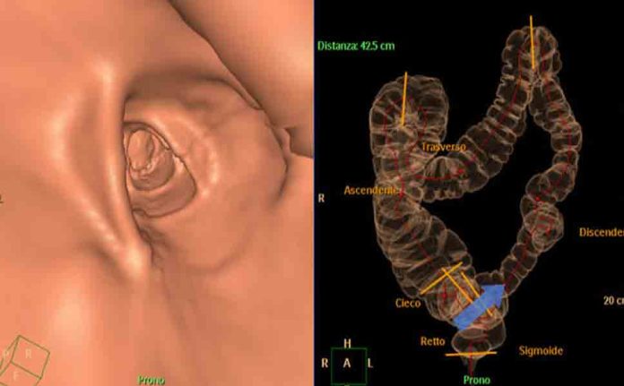 Colonscopia Virtuale: Un Approccio Innovativo alla Prevenzione