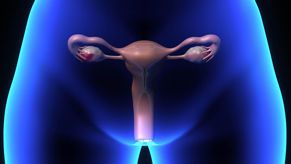 Doppio utero, Adenomiosi