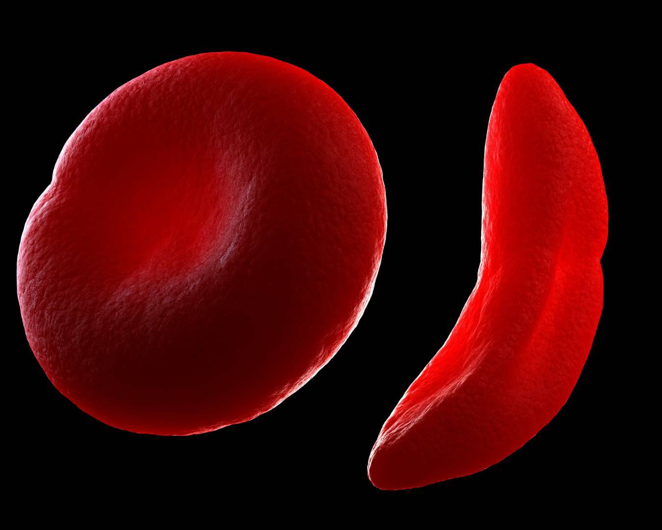 Anemia falciforme 