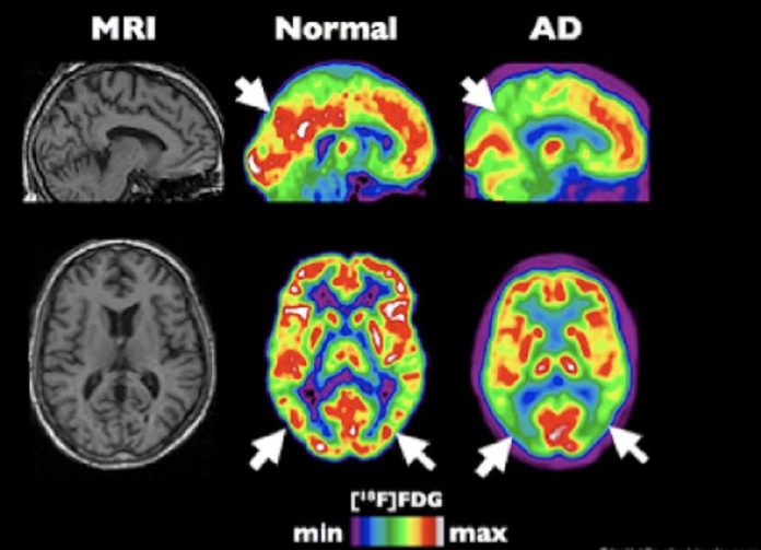 La demenza potrebbe essere curata manipolando le onde cerebrali nel sonno