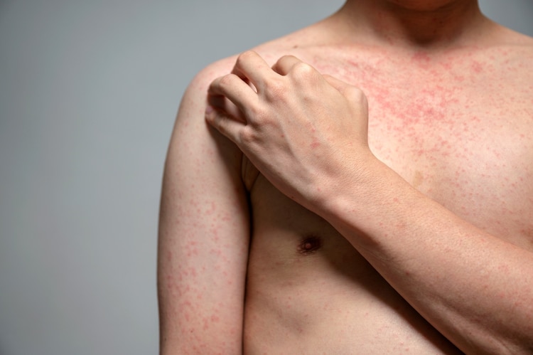 Casi di morbillo in aumento: il boom delle esenzioni vaccinali fa scoppiare l'epidemia 1 Casi di morbillo in aumento: il boom delle esenzioni vaccinali fa scoppiare l'epidemia