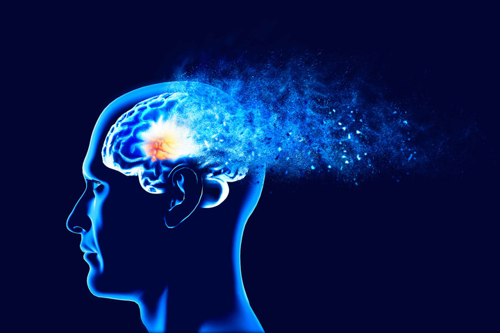 Malattia di Alzheimer: un nuovo farmaco promette di bloccarne la progressione 1 Malattia di Alzheimer: un nuovo farmaco promette di bloccarne la progressione