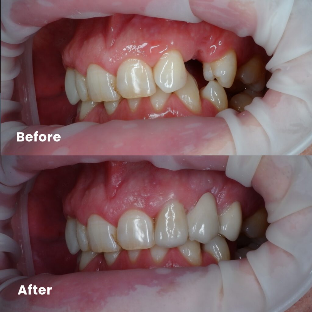 Dental Implant Rejuvie Dental Bali
