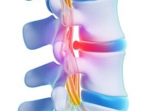 herniated disc