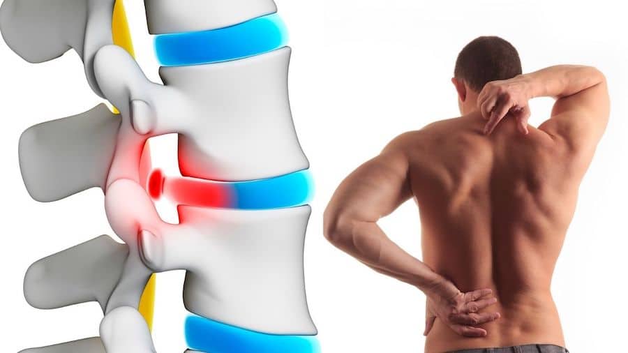 strength training and herniated discs