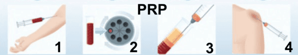 injection prp tendinitis