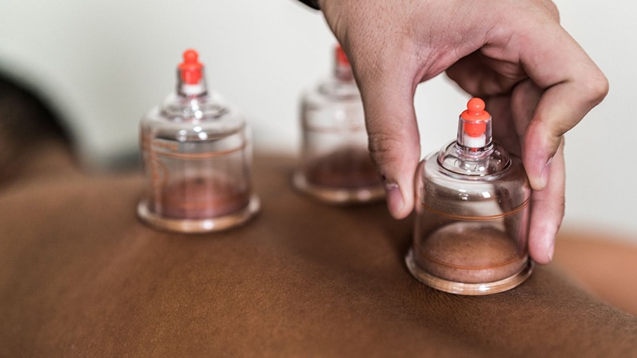 Séance de cupping therapy avec des ventouses placées dans le dos.