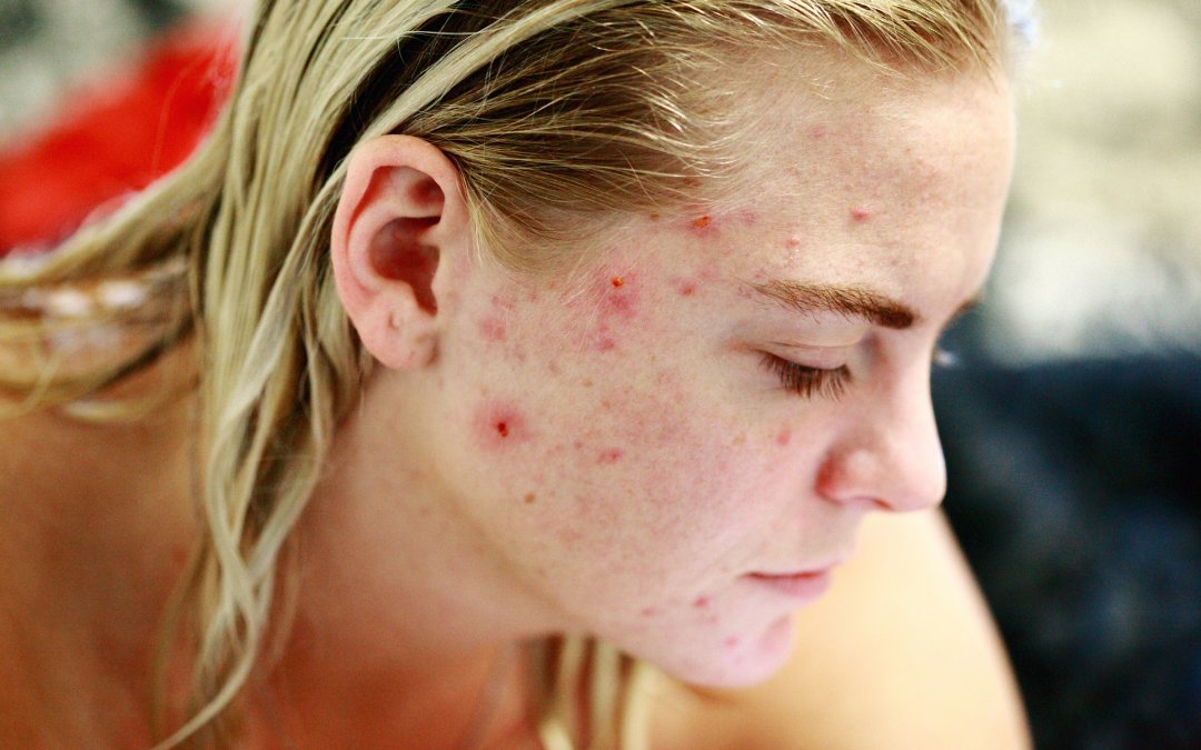 Can a Food Sensitivity Test Help my Acne?