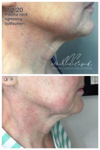 plasma skin tightening"