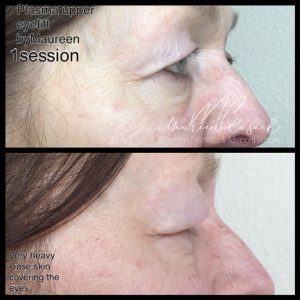 plasma skin tightening"