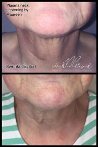 plasma skin tightening"