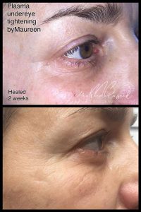 plasma skin tightening"