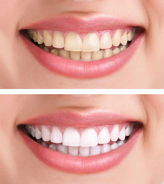 teeth whitening image