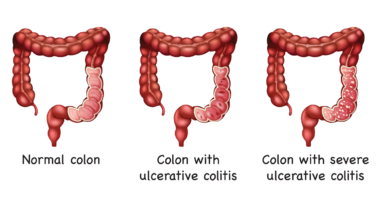 Colitis4