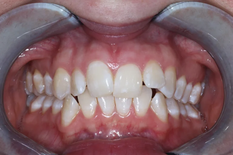 Före Invisalign-behandling av snedställda och trångställda framtänder