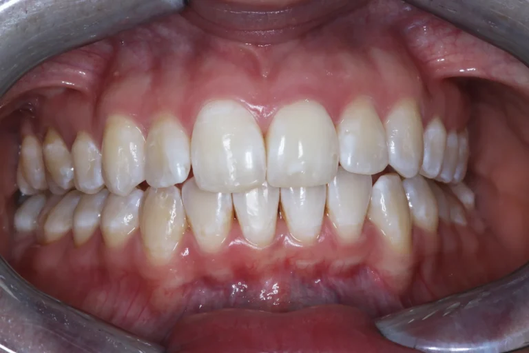 Efter Invisalign-behandling med rakare framtänder – individuellt patientresultat