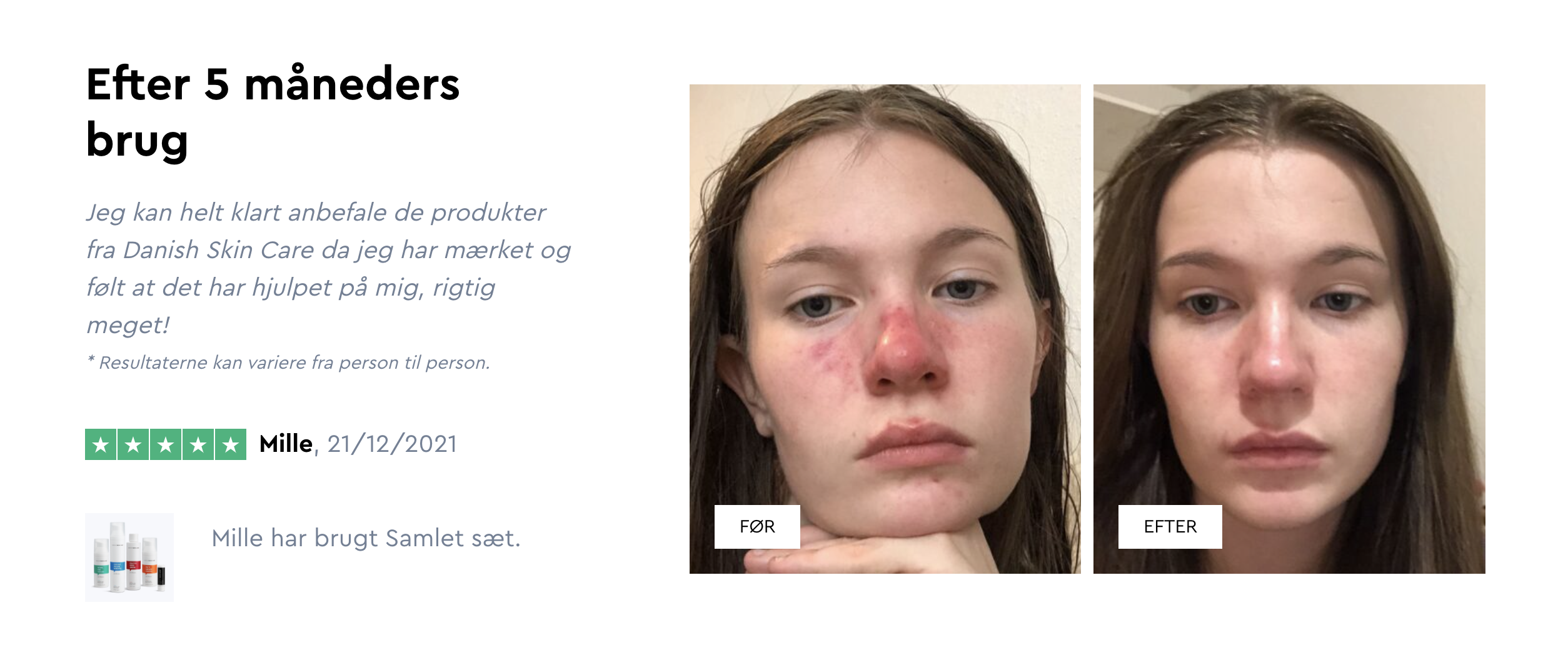 Danish Skin Care anmeldelse: Akne behandling test | Tripii