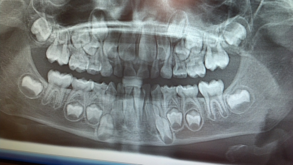 TTD_xray