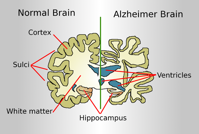 Hjärnan förändras kraftigt för en person med Alzheimers. Foto: Wikipedia/ Garrondo