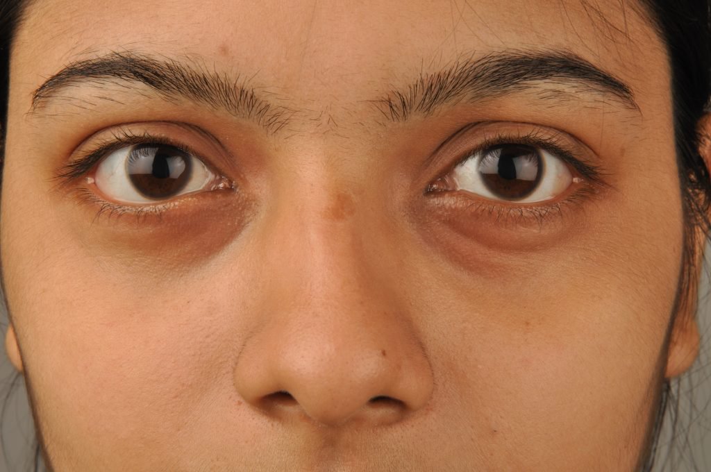 under eye bags