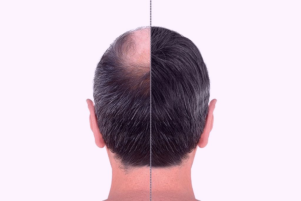 3 belangrijke factoren voor slagingskans haartransplantatie