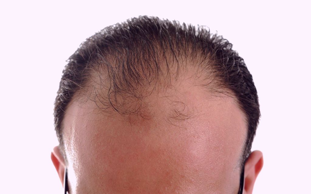 Feiten Haartransplantaties Versus Misvattingen