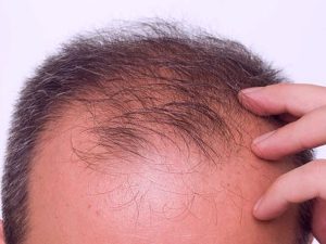 Beste leeftijd voor een haartransplantatie
