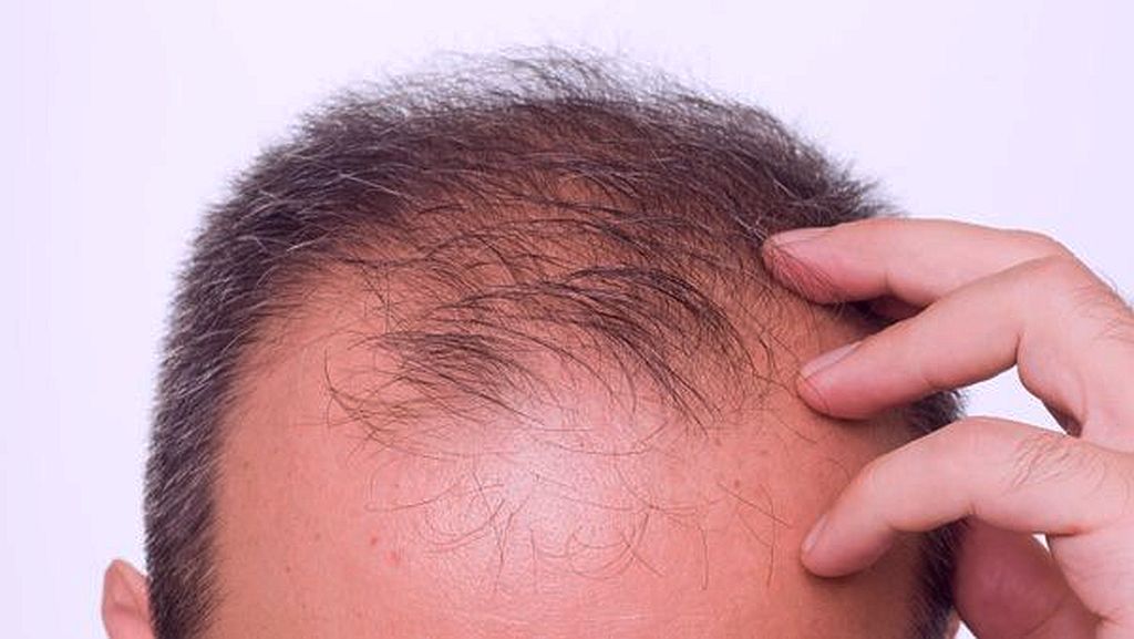 Beste leeftijd voor een haartransplantatie