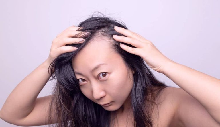 Haartransplantatie Vrouwen