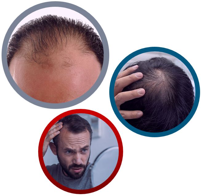 Haartransplantatie mannen Turkije 123