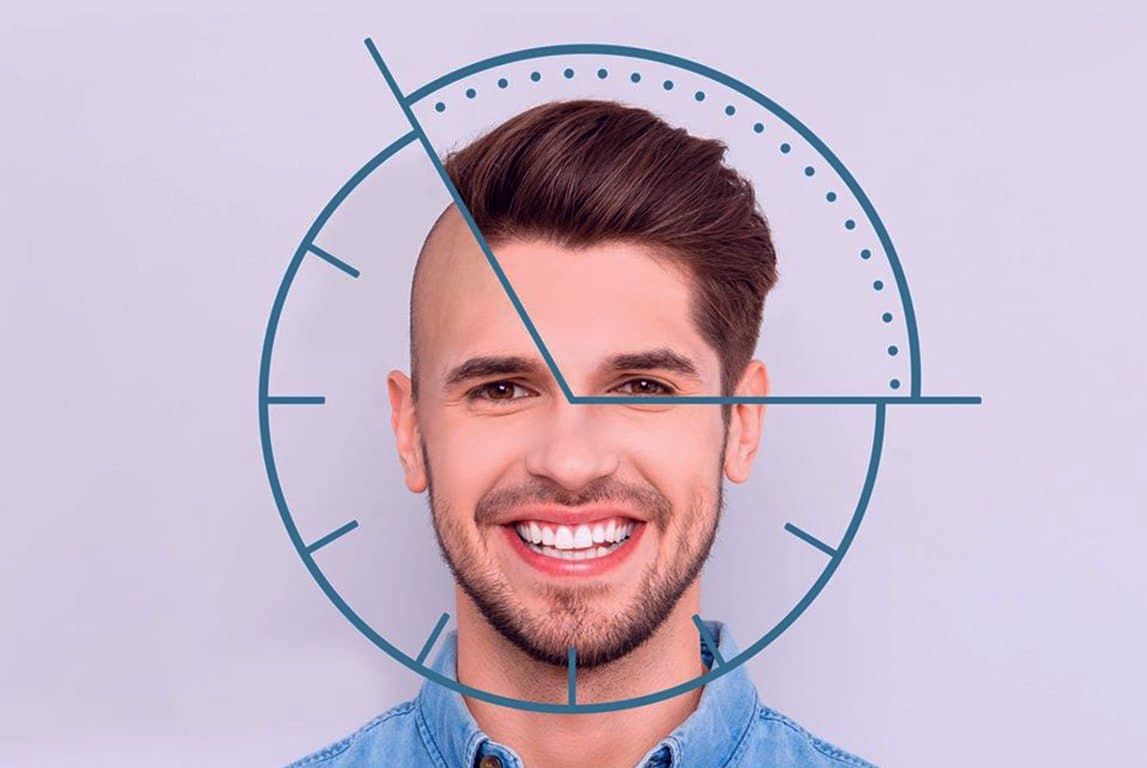 Hoe lang duurt een haartransplantatie operatie?