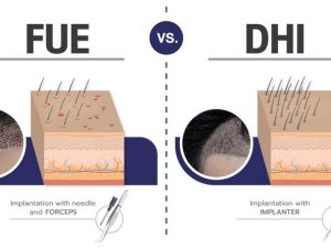 Technieken haartransplantatie