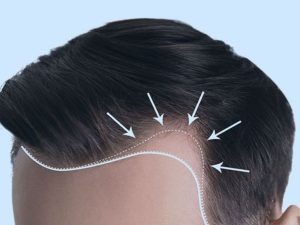 3 factoren die zeggen of je haartransplantatie succesvol was of niet