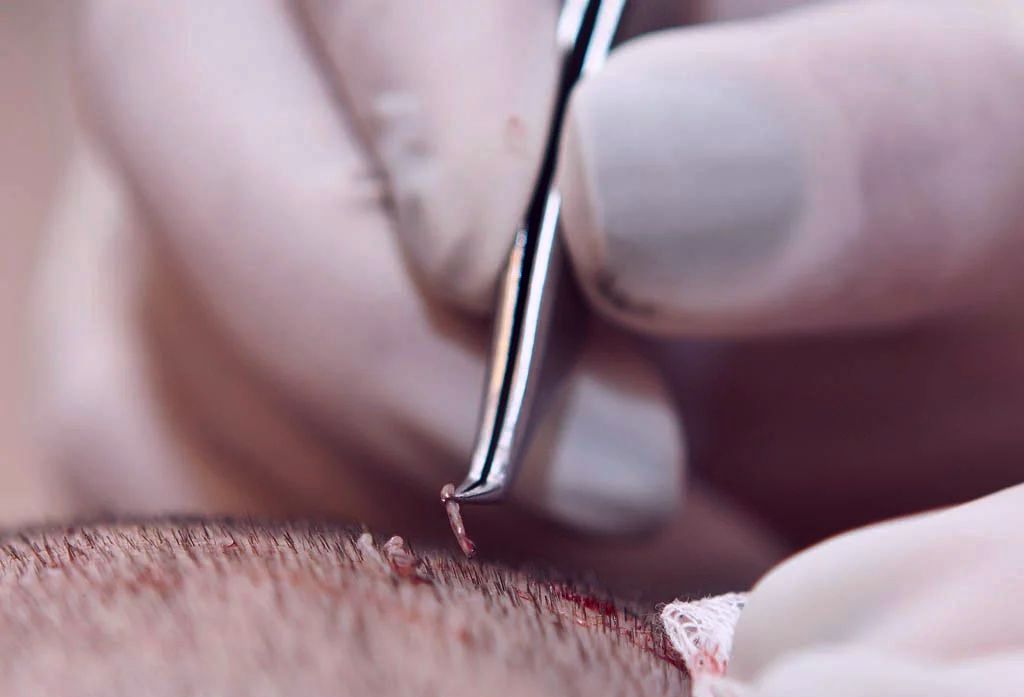 Wat zijn haarzakjes en hoeveel heb ik daarvan?