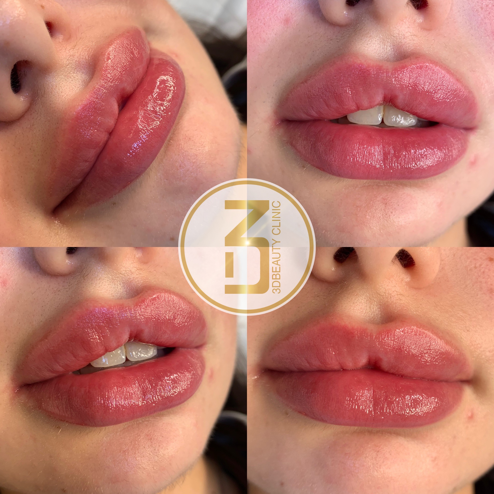 Fillers Läppar | Läpp förstorning och korrigering enligt dina önskemål | Olika läppstilar | Russian lips