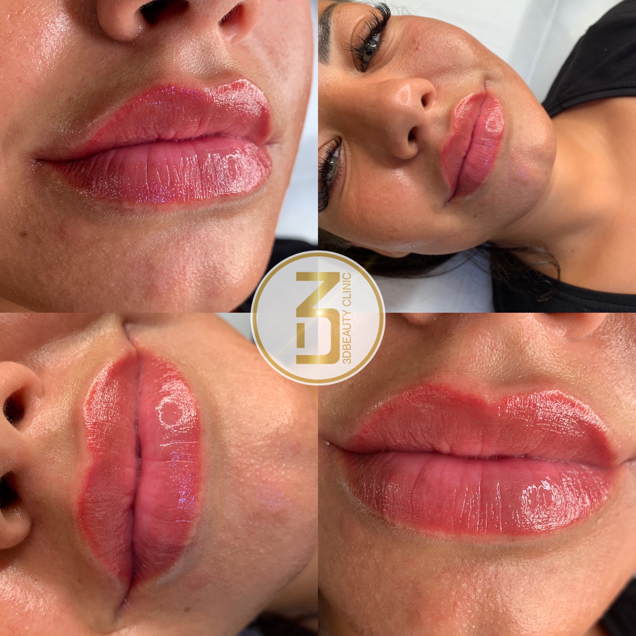 Fillers Läppar | Läpp förstorning och korrigering enligt dina önskemål | Olika läppstilar | Russian lips