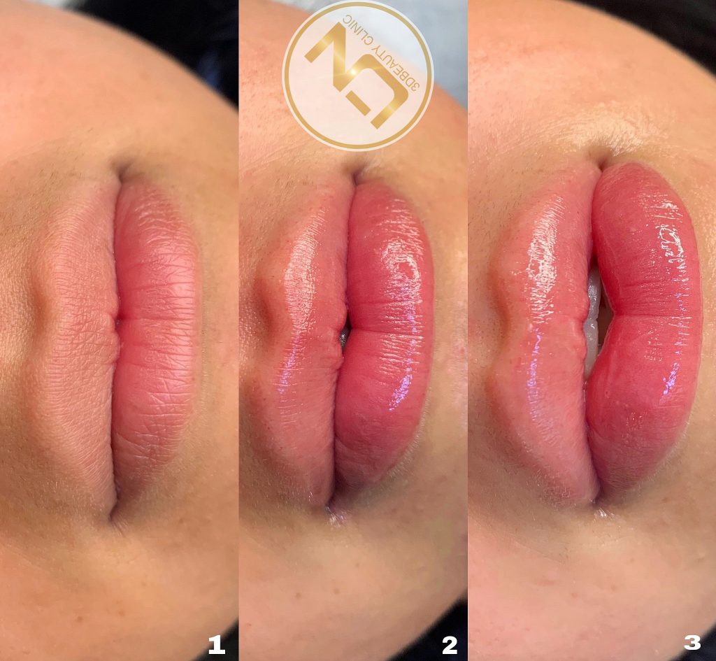 Fillers Läppar | Läpp förstorning och korrigering enligt dina önskemål | Olika läppstilar | Russian lips