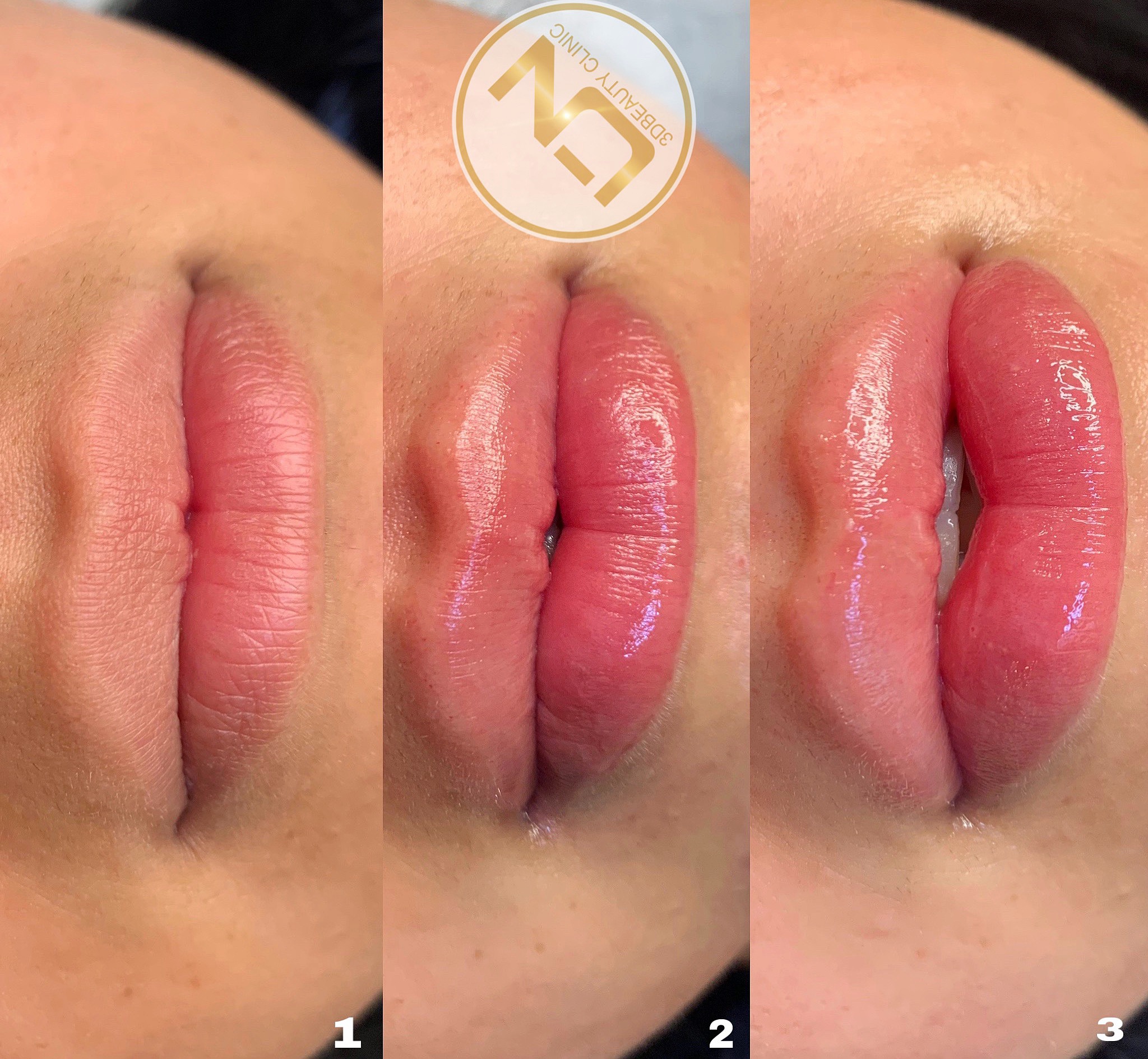 Fillers Läppar | Läpp förstorning och korrigering enligt dina önskemål | Olika läppstilar | Russian lips