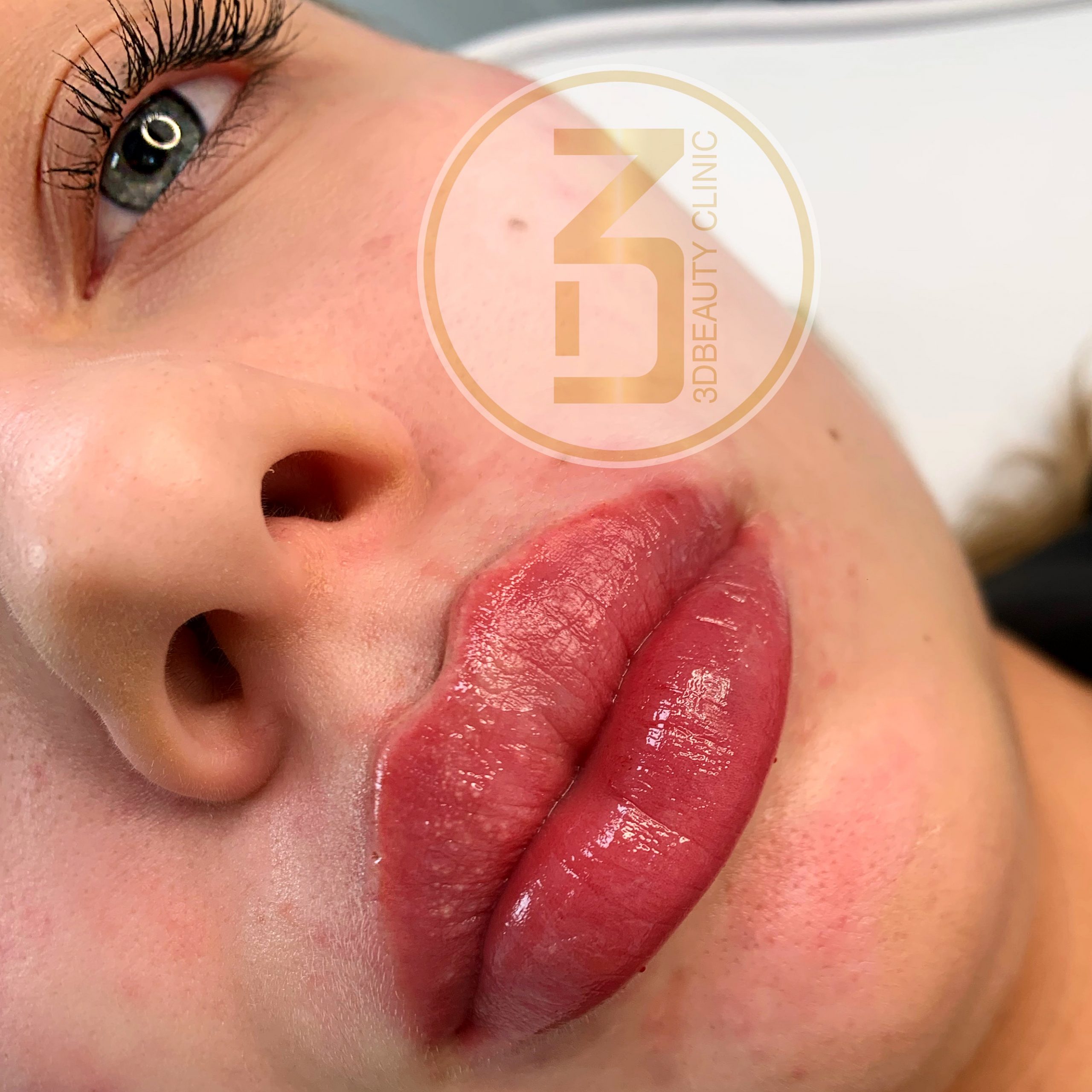 Fillers läppar för välformade läppar med lite extra volym - 3dbeauty Clinic