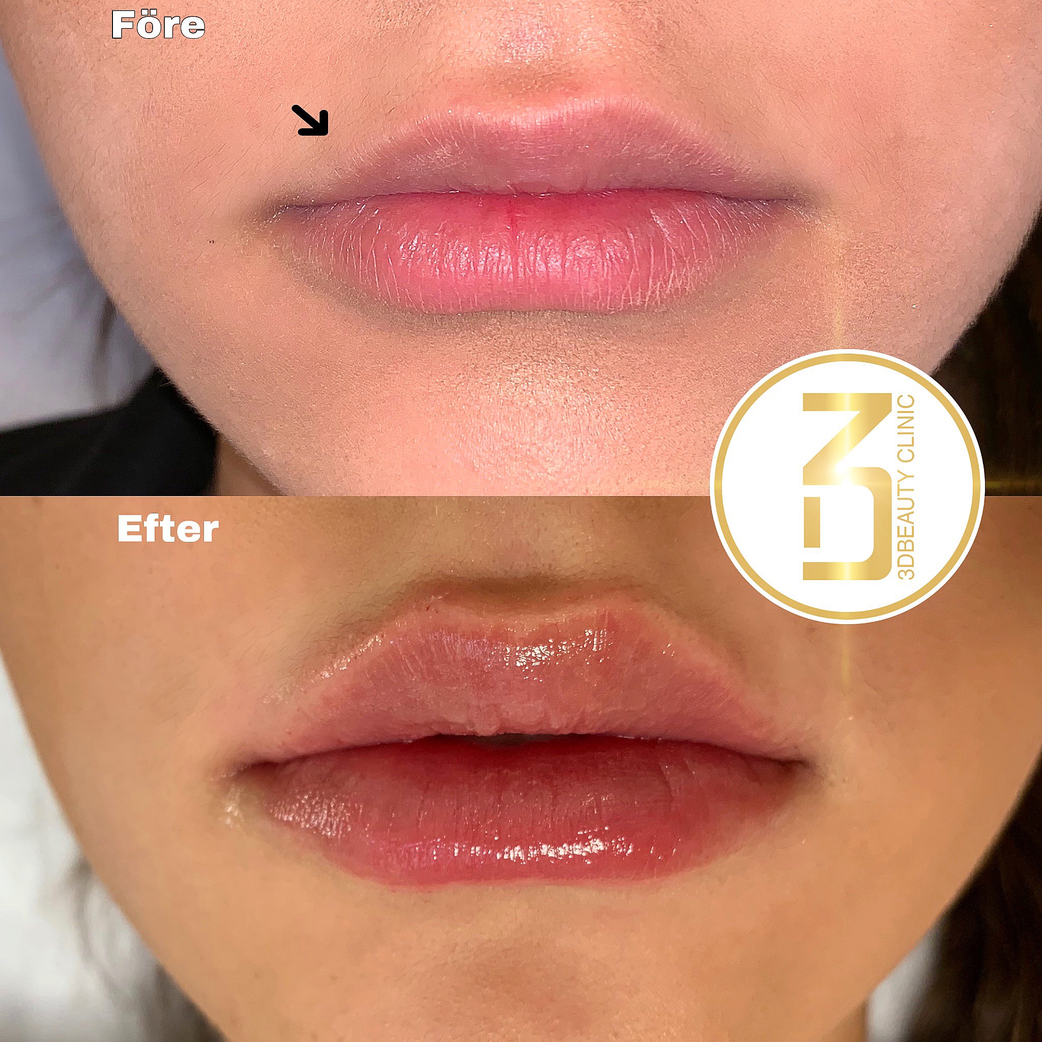 Fillers Läppar | Läpp förstorning och korrigering enligt dina önskemål | Olika läppstilar | Russian lips