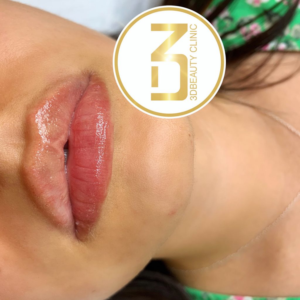 Fillers Läppar | Läpp förstorning och korrigering enligt dina önskemål | Olika läppstilar | Russian lips